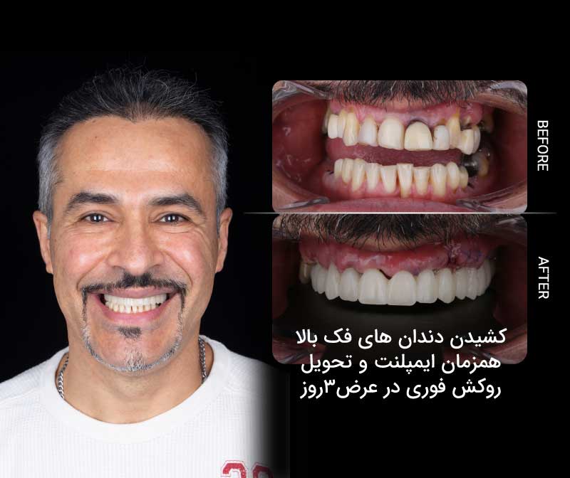 تحویل روکش فوری در عرض 3 روز